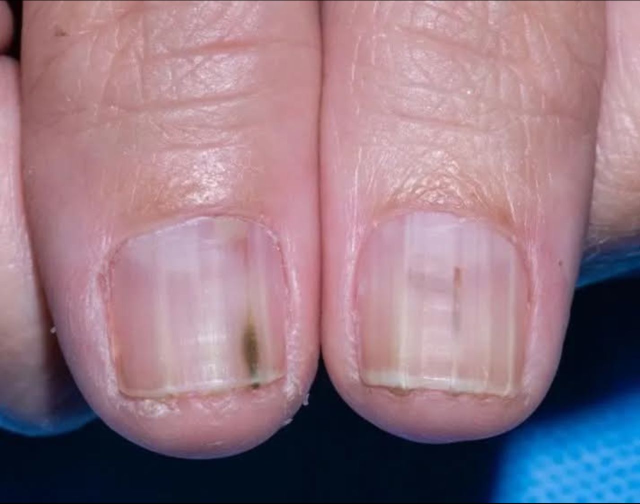 Rippled fingernails reveal secrets of possible disease